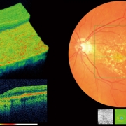 OCT scan showing the surface of the eye and the back of the eye